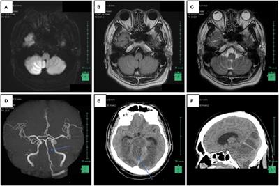 Case report: Fatal ischemic stroke induced by unruptured traumatic intracranial vertebral artery dissection